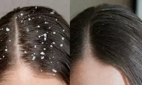 रूसी को ठीक करने के उपाय