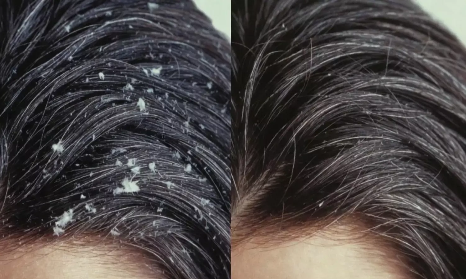 रूसी कम करने घरेलू उपाय