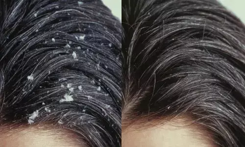 रूसी कम करने घरेलू उपाय