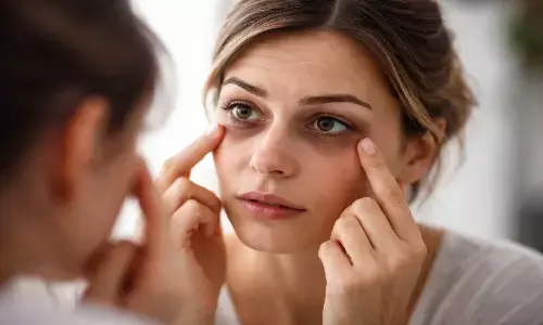 dark circles causes