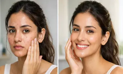 पिंपल की समस्या ठीक करने उपाय