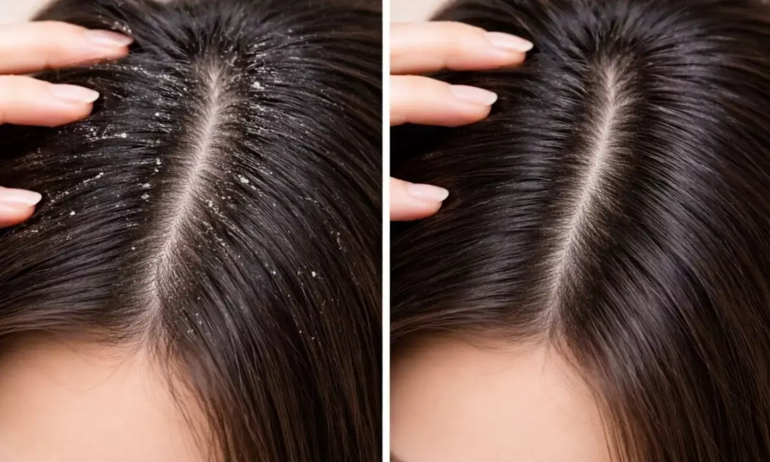 रूसी की समस्या