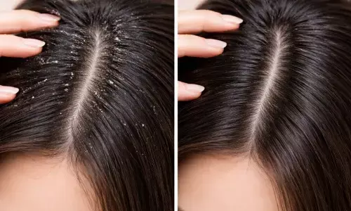 रूसी की समस्या