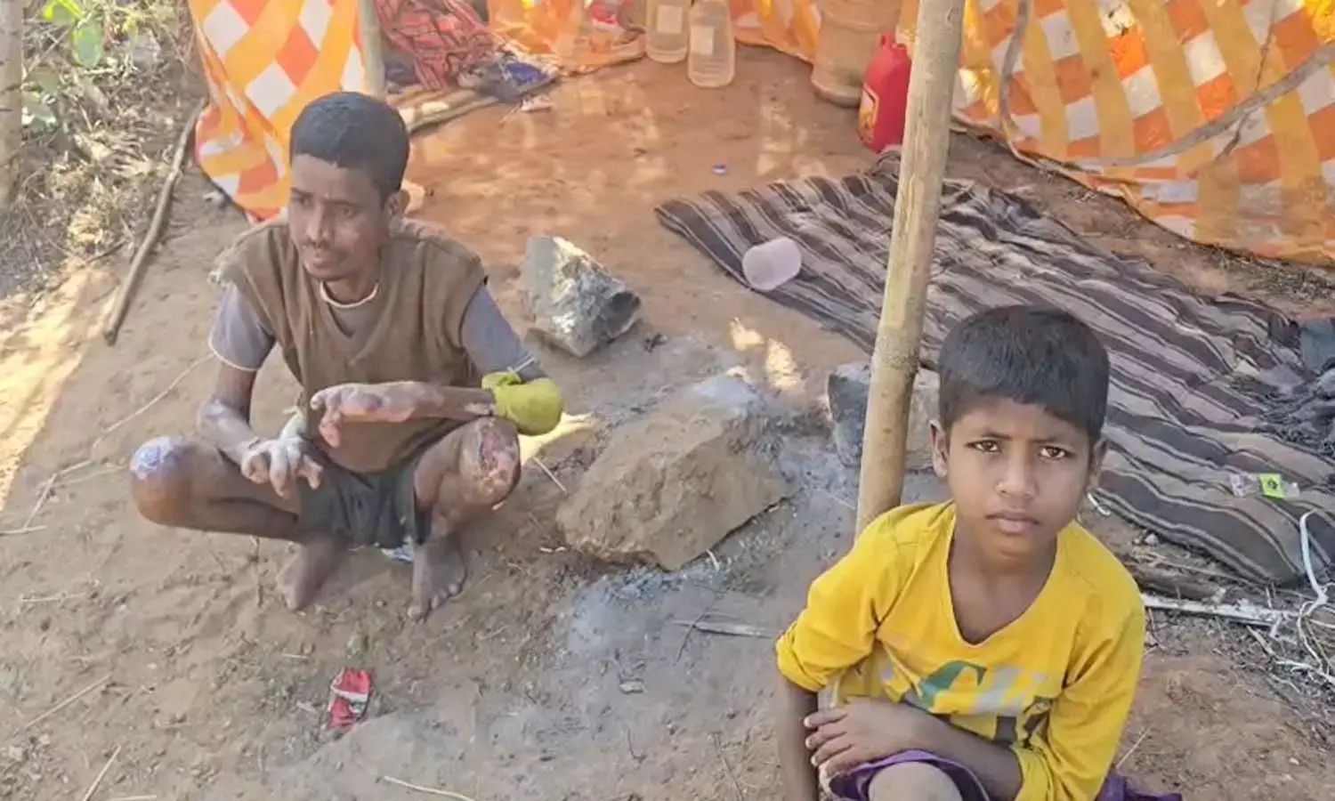 धर्म- बीमारी और गरीबी के बीच फंसा आदिवासी परिवार : कुष्ठ रोग से पीड़ित होने की वजह से पंचायत ने गांव किया बेदखल, अब मदद की दरकार