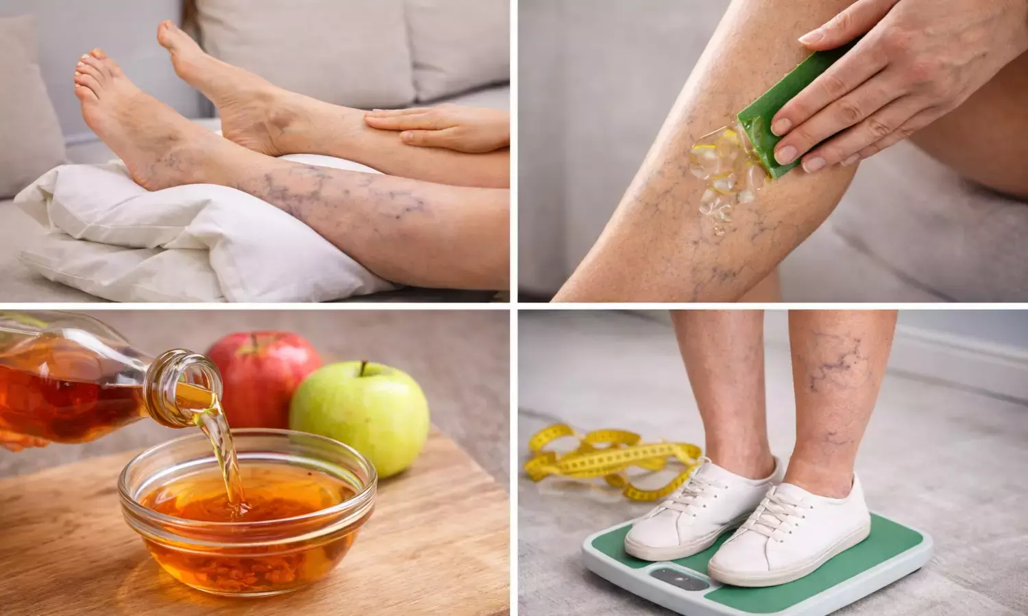 Home remedies for varicose veins relief