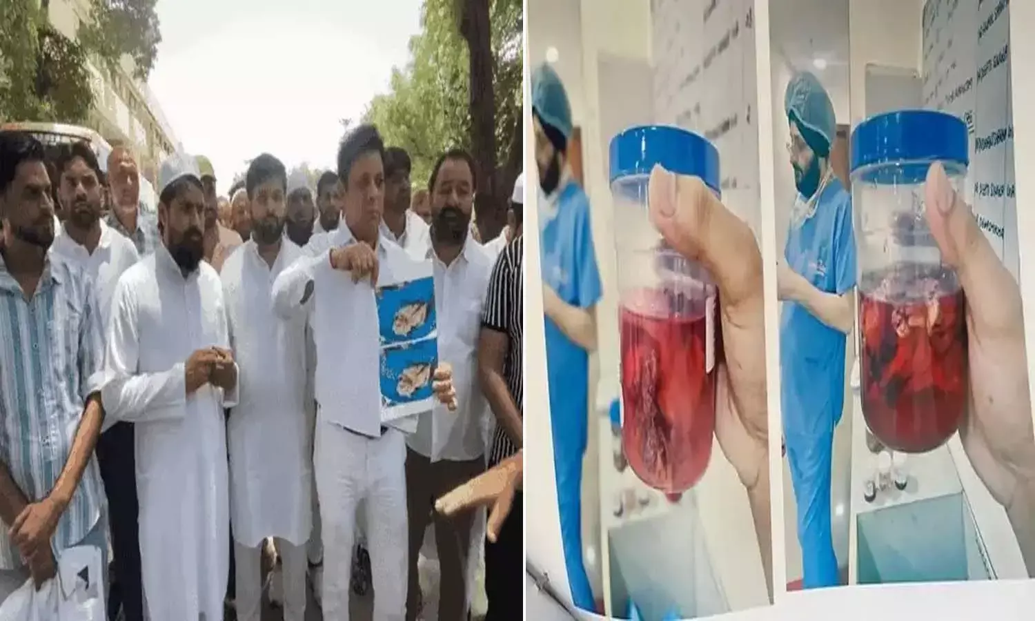 Surgical Sponge left in Uterus Surgical Sponge left in Uterus