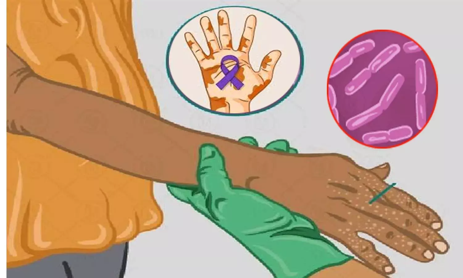 सिस्टम में गड़बड़ी :   छत्तीसगढ़ में अब 17 की जगह 22 जिले कुष्ठ रोग चिन्हित, रेड जोन में 6