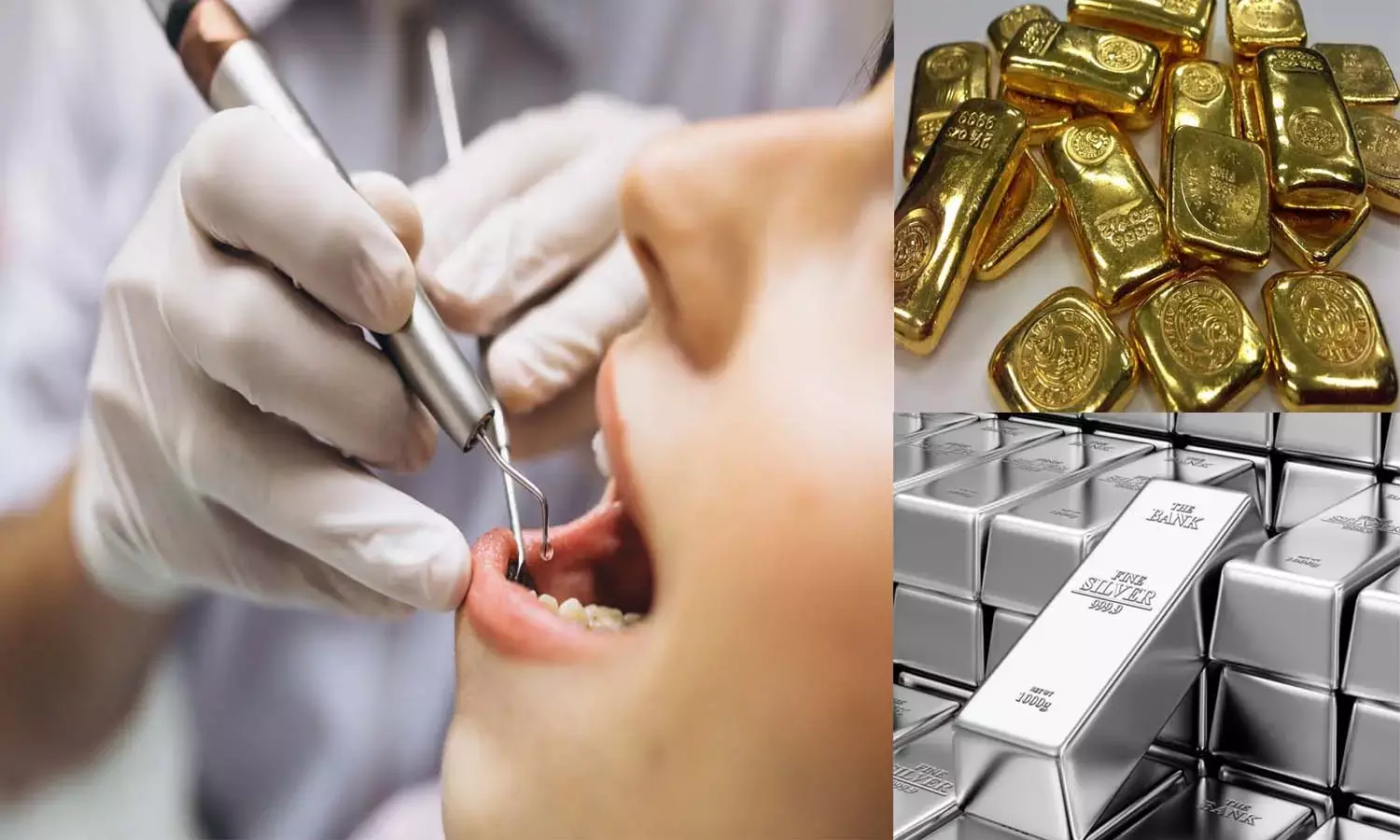 दांतों में महंगाई का दर्द : सोना बंद, चांदी भरना चार गुना महंगा सरकारी अस्पताल में राहत क्योंकि यहां सालभर का स्टॉक